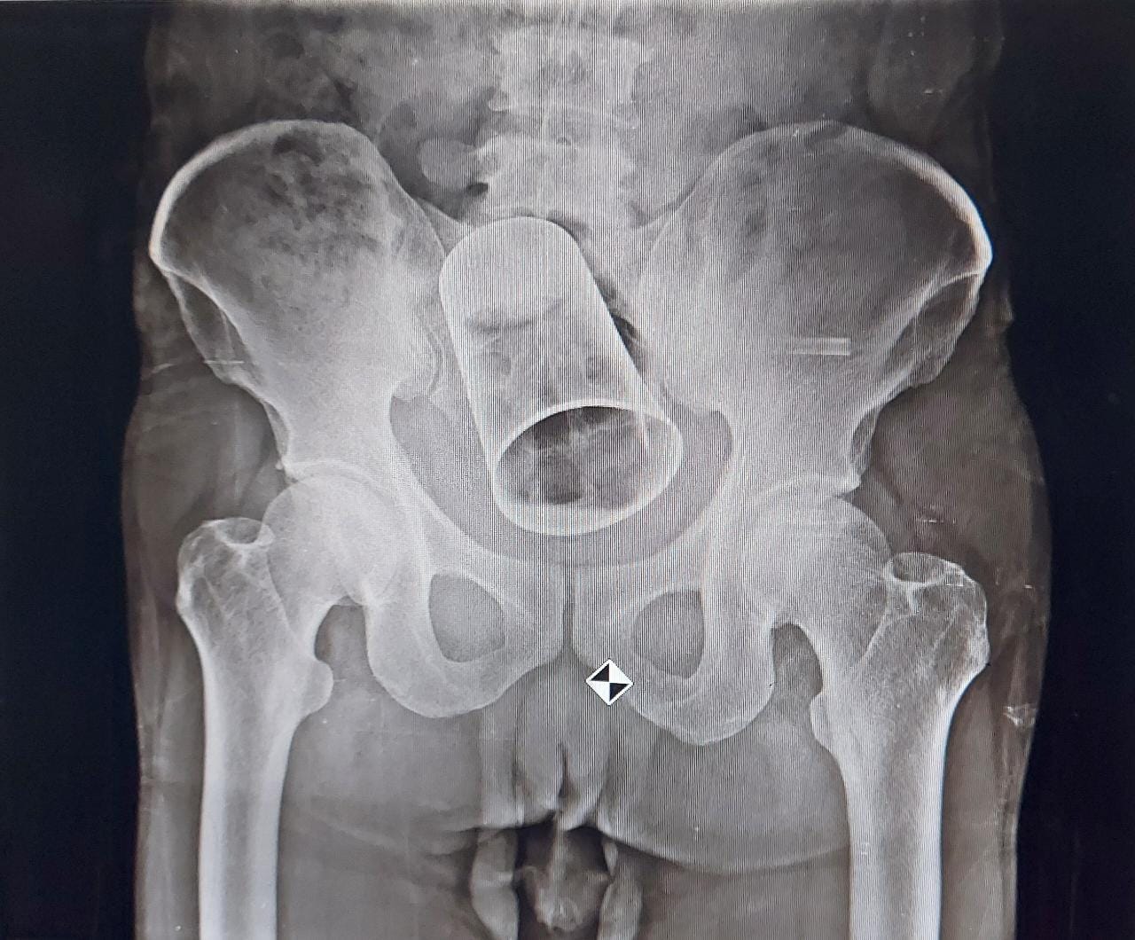 ପେଟ ଭିତରୁ ବାହାରିଲା ଷ୍ଟିଲ ଗ୍ଲାସ୍, MKCGରେ ହେଲା ବିରଳ ଅସ୍ତ୍ରୋପଚାର